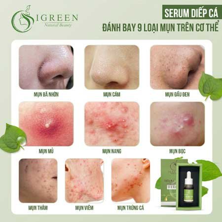 serum trị mụn diếp cá igreen đánh bay các loại mụn