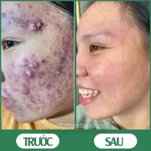 serum trị mụn diếp cá igreen