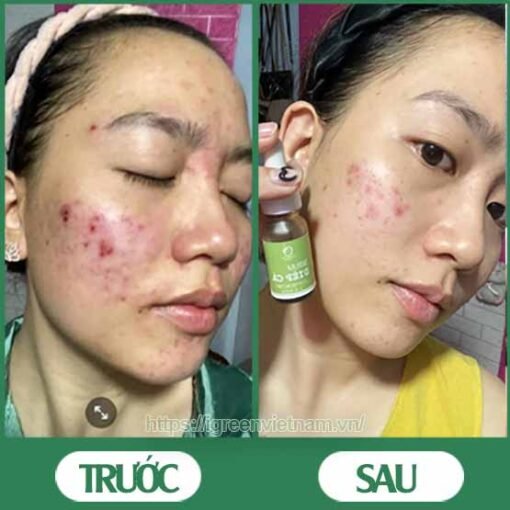 serum trị mụn diếp cá igreen