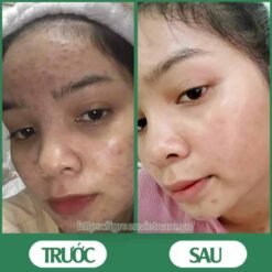 serum trị mụn diếp cá igreen